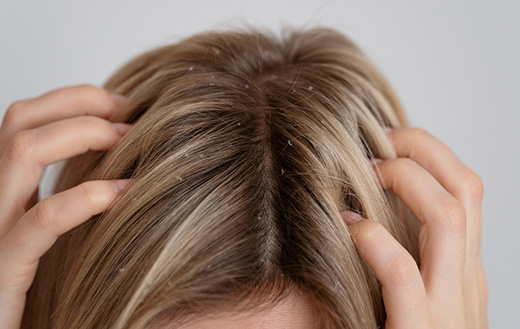 Заболевания кожи головы (перхоть, себорея) | Столичная медицинская клиника